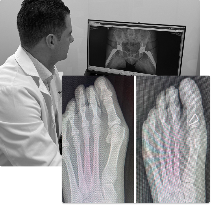 hallux valgus